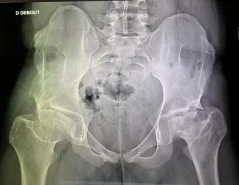 hanche arthrosique orthopédie